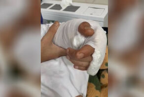 جراحان تبریزی سومین پیوند موفق ساعد دست در جهان را رقم زدند