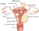 فیبروم رحمی چگونه درمان می‌شود؟ بررسی گزینه‌های دارویی، جراحی و آمبولیزاسیون