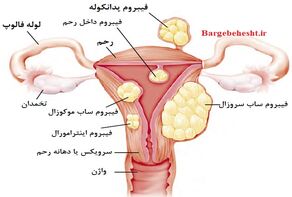 فیبروم رحمی چگونه درمان می‌شود؟ بررسی گزینه‌های دارویی، جراحی و آمبولیزاسیون