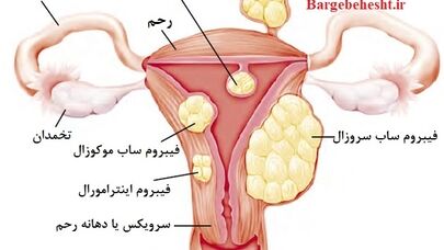 فیبروم رحمی چگونه درمان می‌شود؟ بررسی گزینه‌های دارویی، جراحی و آمبولیزاسیون